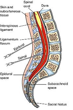 When to chose Epidural Anesthesia